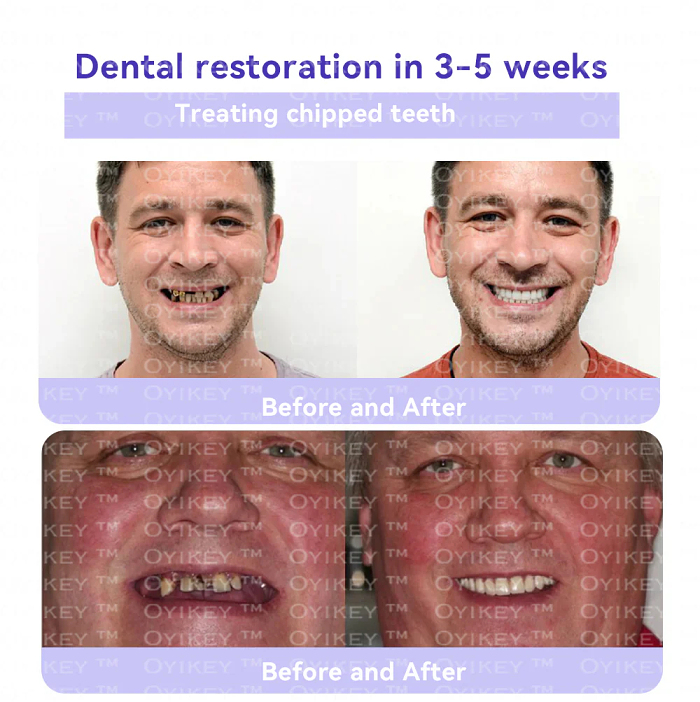 💕OyikeyTM  TOOTH RESTORATIONMINERAL POWDER(ADA recommended)
