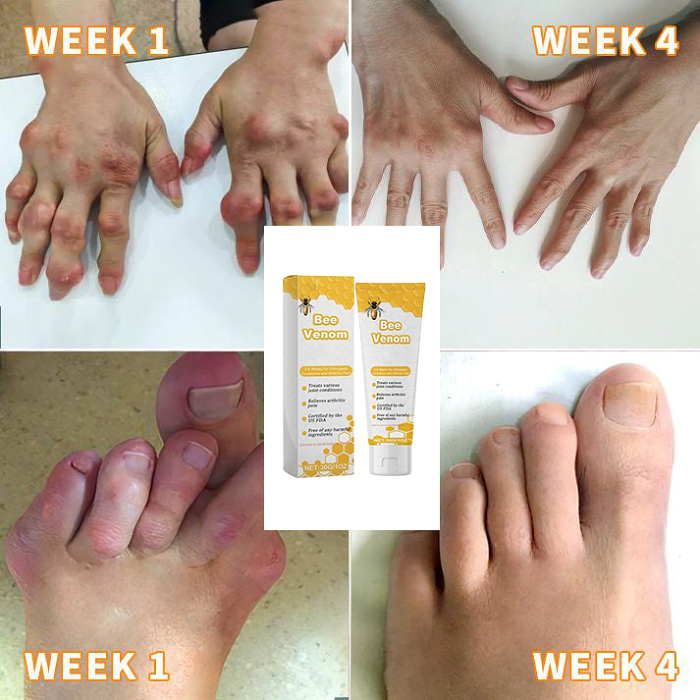 TAILEDEN™  Bee poison Joint Therapy Pain Relief Gel