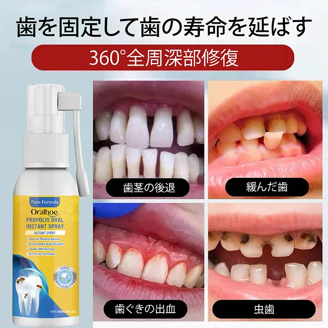 🦷日本齒科醫師協會及👨‍⚕️東大醫學院共同研製【Oralhoe蜂胶口腔护理喷雾】已拯救百萬各類牙齒疼痛、殘缺、不齊、口臭等問題人士✅減輕炎症、美白牙齒、除口臭、恢復牙齦健康💟輕鬆便捷，出門隨身帶🩸促進牙齦再生長，延長牙齒壽命👍輕鬆解決牙裂/牙洞/牙縫/牙垢