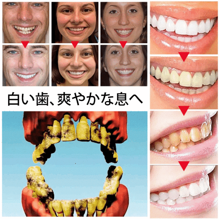 🦷日本齒科醫師協會及👨‍⚕️東大醫學院共同研製【Oralhoe蜂胶口腔护理喷雾】已拯救百萬各類牙齒疼痛、殘缺、不齊、口臭等問題人士✅減輕炎症、美白牙齒、除口臭、恢復牙齦健康💟輕鬆便捷，出門隨身帶🩸促進牙齦再生長，延長牙齒壽命👍輕鬆解決牙裂/牙洞/牙縫/牙垢