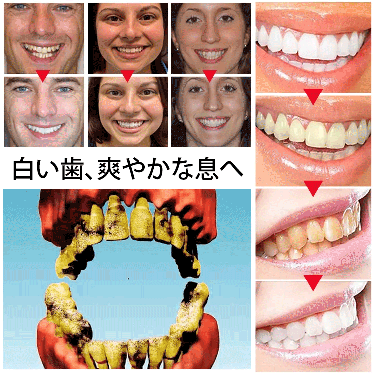 🦷日本齒科醫師協會及👨‍⚕️東大醫學院共同研製【Oralhoe蜂胶口腔护理喷雾】已拯救百萬各類牙齒疼痛、殘缺、不齊、口臭等問題人士✅減輕炎症、美白牙齒、除口臭、恢復牙齦健康💟輕鬆便捷，出門隨身帶🩸促進牙齦再生長，延長牙齒壽命👍輕鬆解決牙裂/牙洞/牙縫/牙垢