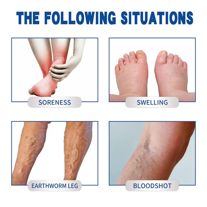 South Moon Varicose Veins Cream