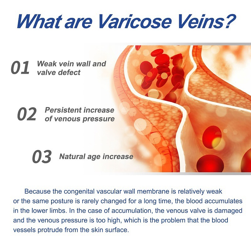 South Moon Varicose Veins Cream