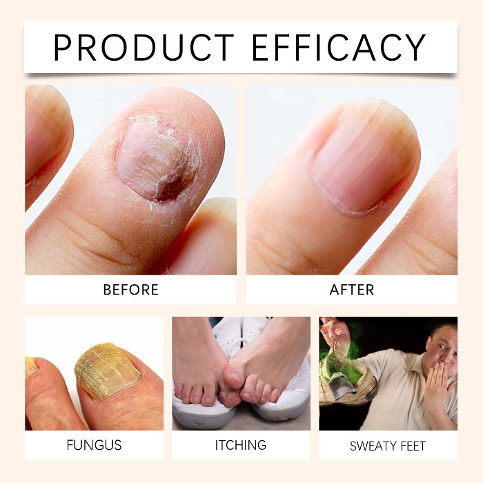 HOUKEA™ Bee Venom Advanced Nail Repair Spray