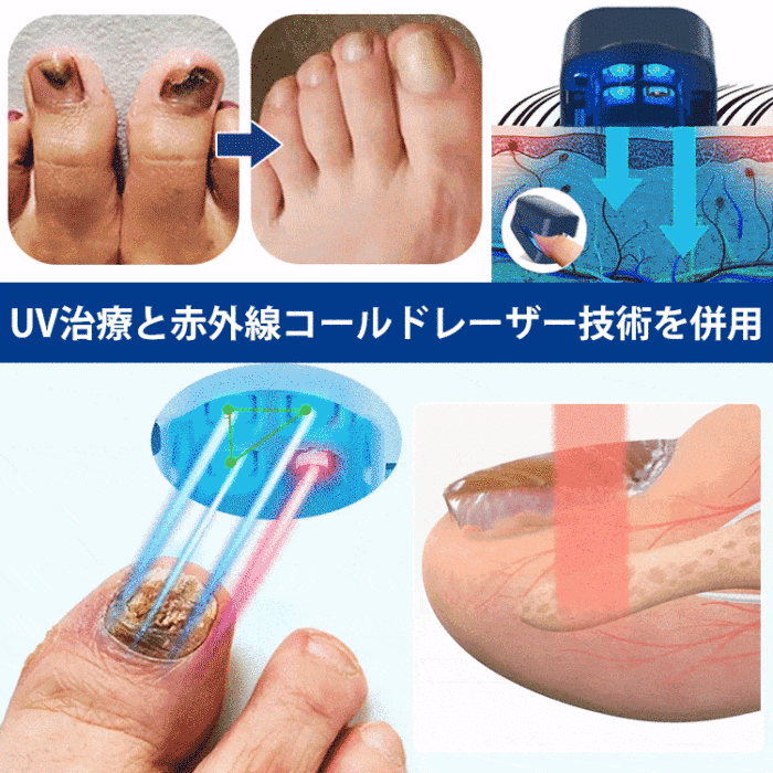 【日本醫師推薦✅藥店熱銷】家用便攜灰指甲甲癬專用激光治療儀