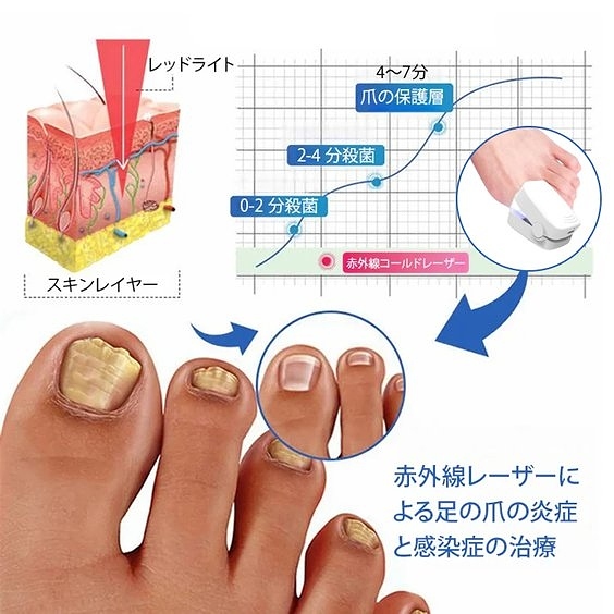【日本醫師推薦✅藥店熱銷】家用便攜灰指甲甲癬專用激光治療儀