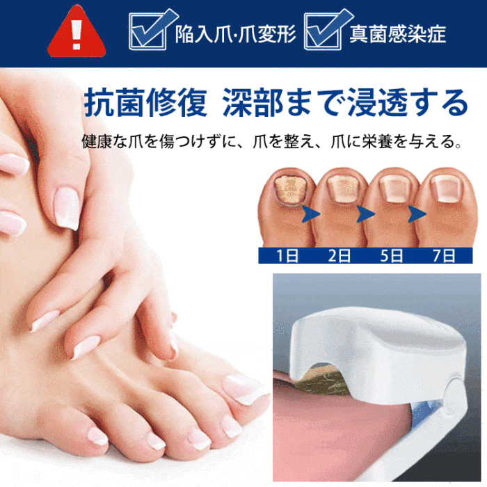 【日本醫師推薦✅藥店熱銷】家用便攜灰指甲甲癬專用激光治療儀