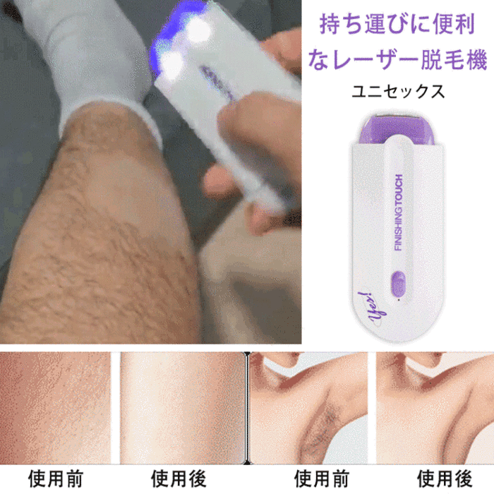美容外科学会推薦！【男女兼用】スマート無痛脱毛機！脱毛・美肌・黒ずみケア