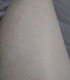 美容外科学会推薦！【男女兼用】スマート無痛脱毛機！脱毛・美肌・黒ずみケア
