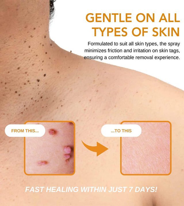 Australia Wart Care Spray