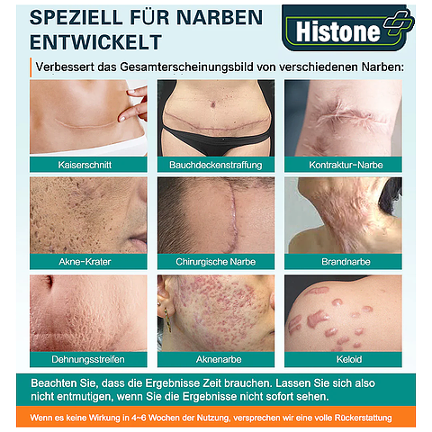 Advanced Scar Spray For All Types of scars -For example Acne Scars, Surgical scars and Stretch Marks