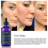 15% Peeling Trichloroacetic Acid TCA Solution Skin Care Chemical Peel Whitening Brightening Pigmentation Serum For Face