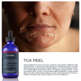 15% Peeling Trichloroacetic Acid TCA Solution Skin Care Chemical Peel Whitening Brightening Pigmentation Serum For Face