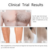 Ice Freezing epilator handset diy ipl laser hair removal handheld permanently laser hair removal from home ipl hair removeal