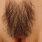 Implanted Pubic Hair #3