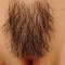 Implanted Pubic Hair #3
