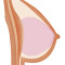 Gel-filled Breast
