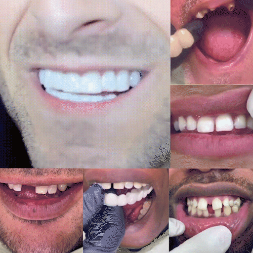 Adjustable bite-in dentures! 50% off for a limited time on the last day!