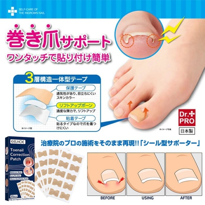 巻き爪矯正シール