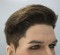 Hair transplant